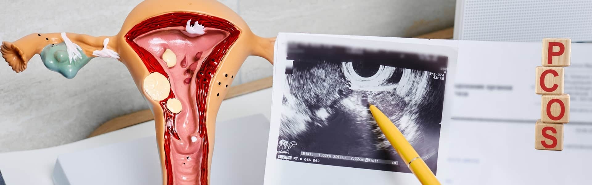 טיפול טבעי בשחלה פוליציסטית PCOS – איור רפואי של שחלות